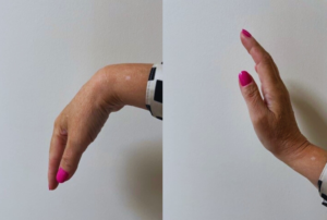 Understanding Repetitive Strain Injury RSI ROC Health